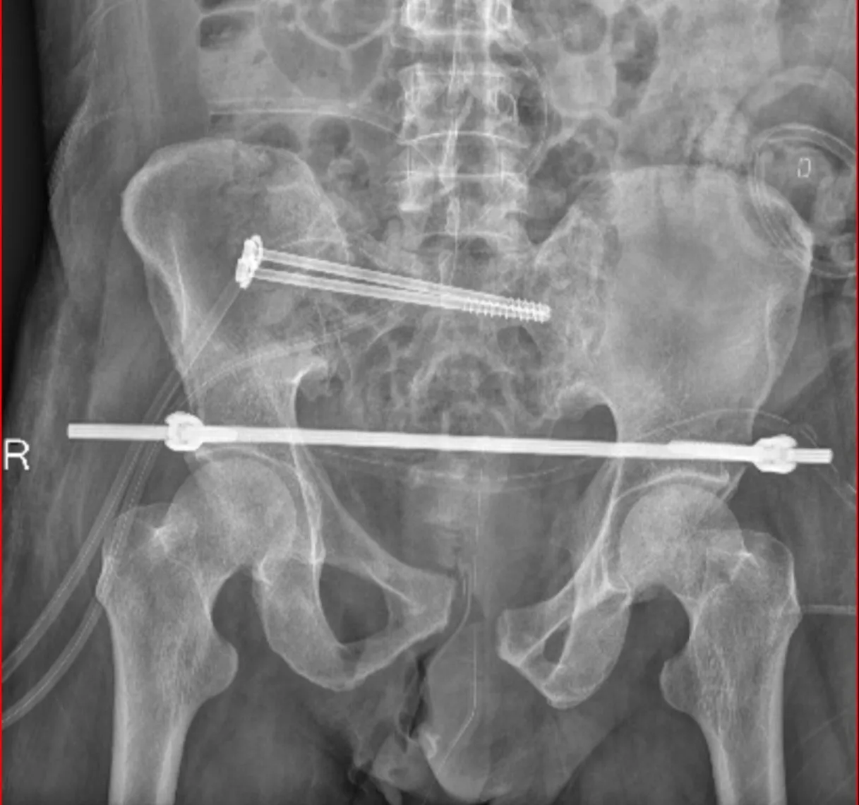 Post-operative X-ray after hip fixation surgery
